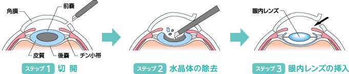 1.切開→2.水晶体の除去→3.眼内レンズの挿入