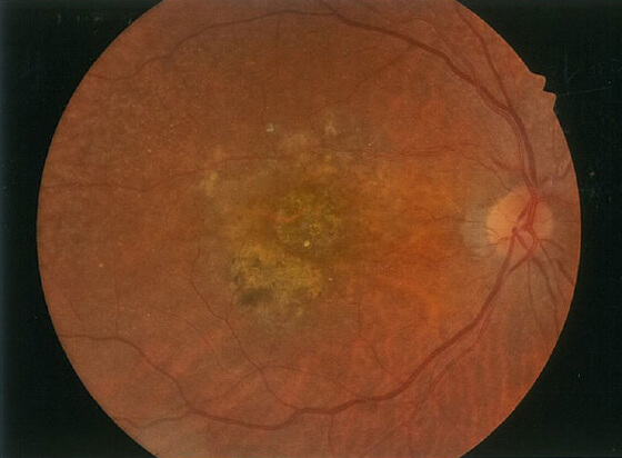 眼底検査による画像