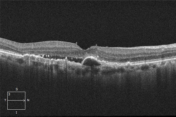 OCT検査による画像