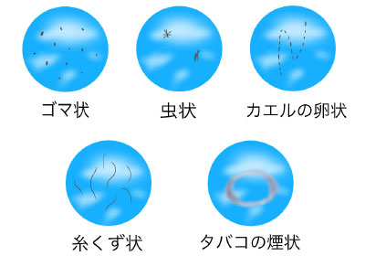 飛蚊症の見え方イラスト