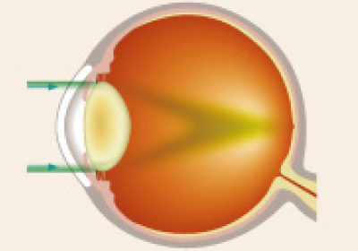 白内障の眼球イラスト