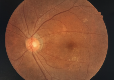糖尿病網膜症の眼底写真